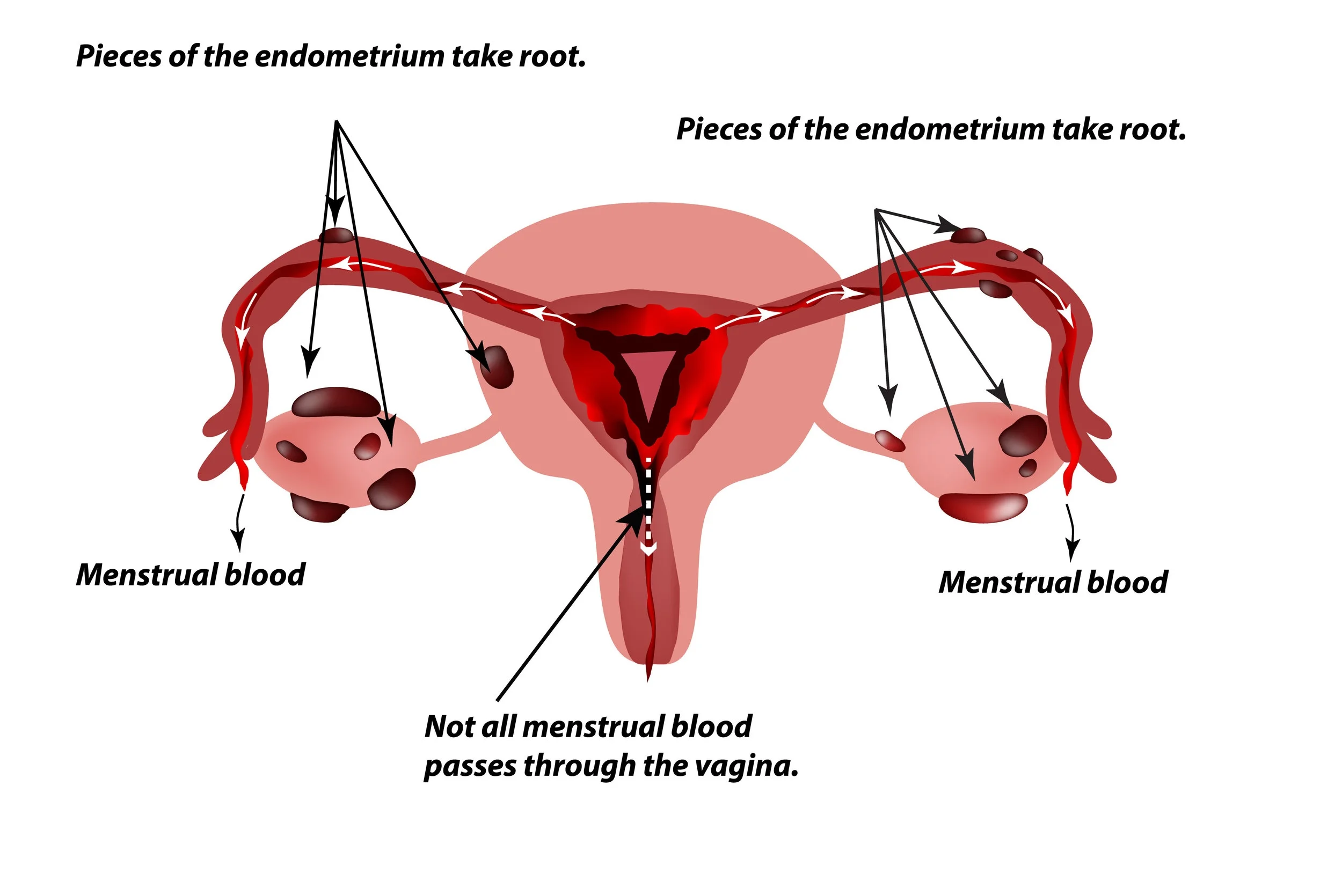 Endometrioza: Ghid complet de diagnostic şi tratament